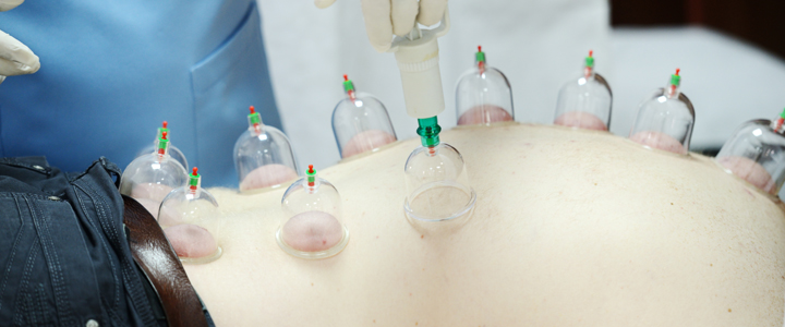 Hijama The Super Sunnah that will make you Uber Healthy